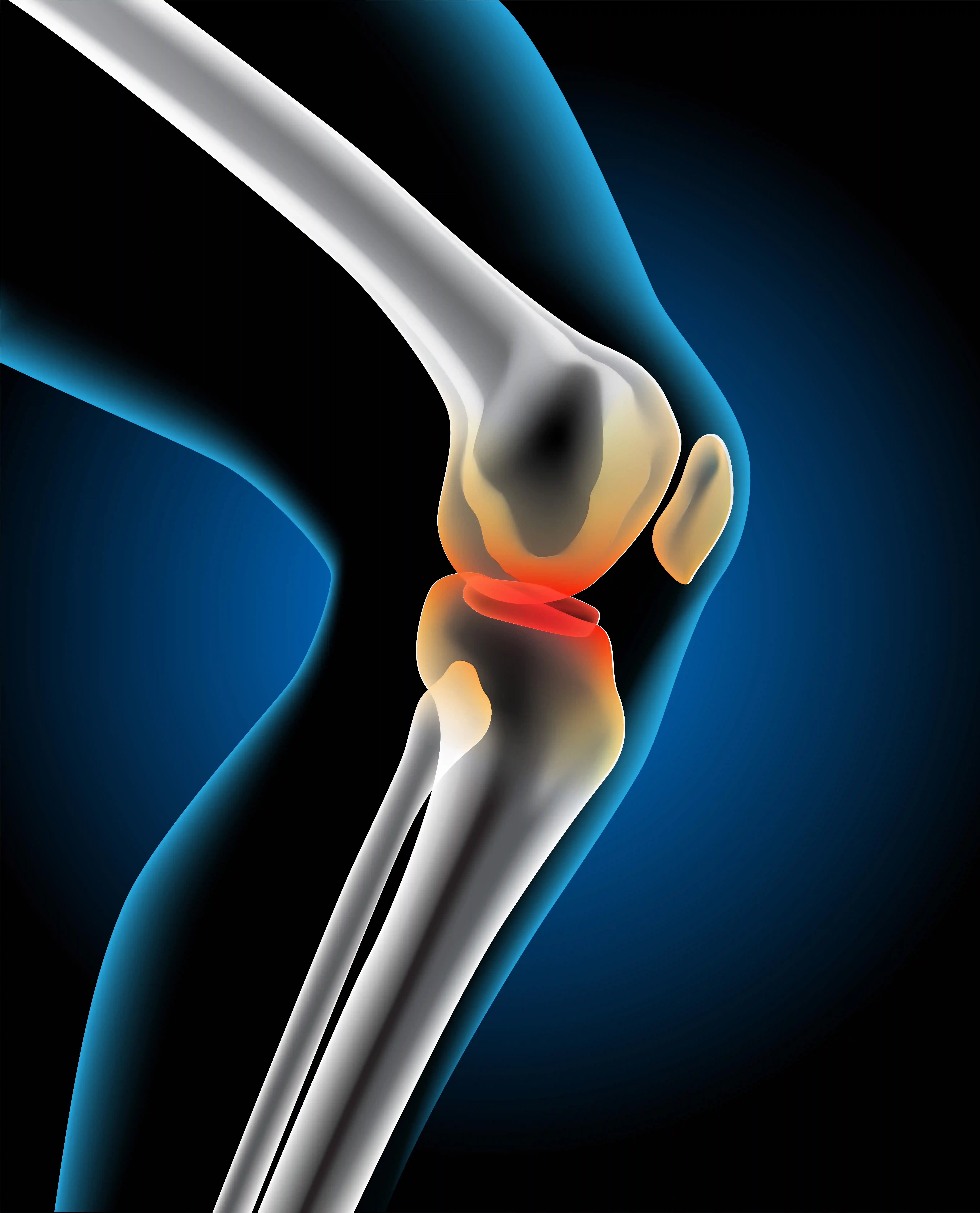 Multi-Ligament Knee Injuries
